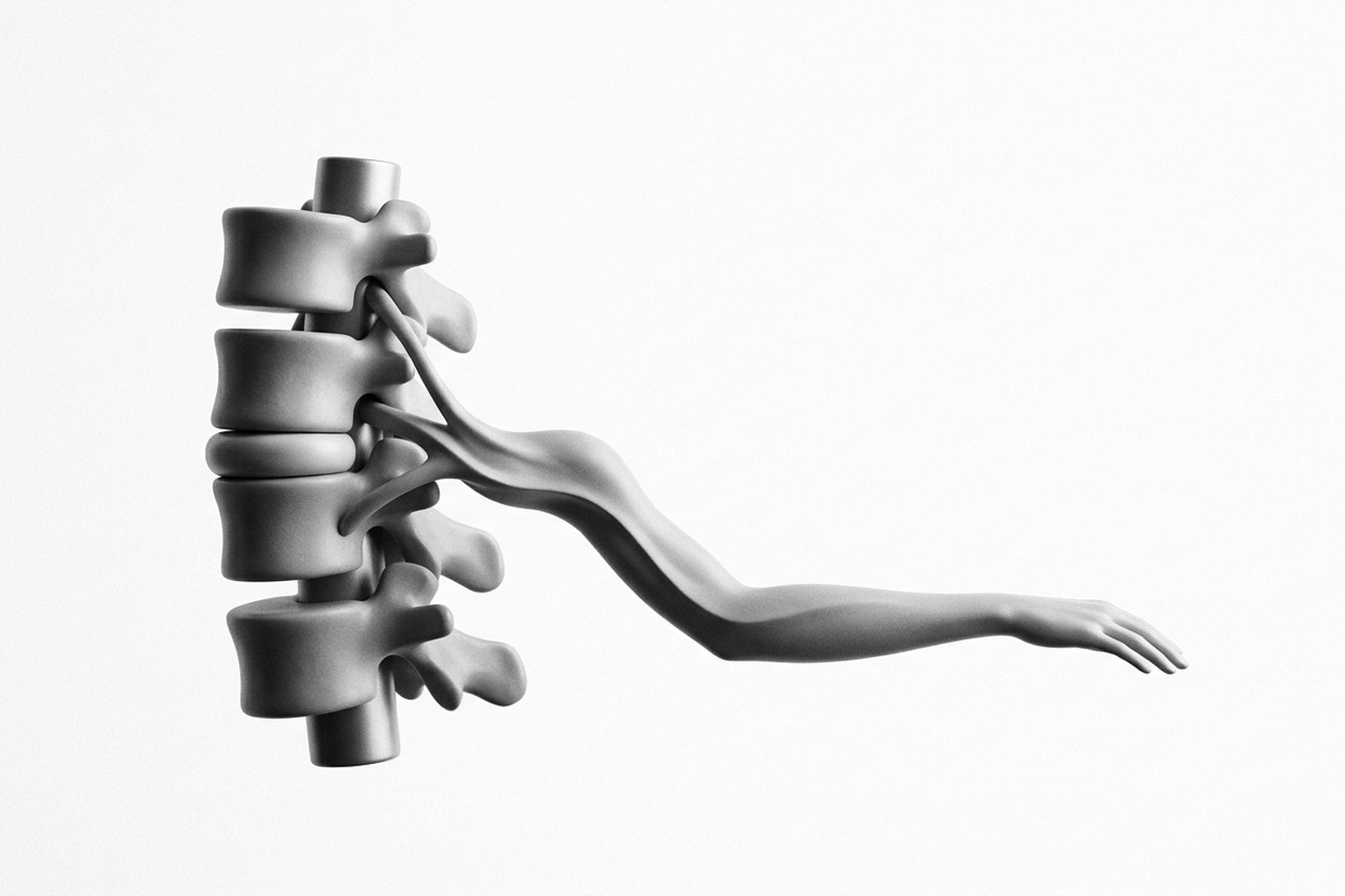 Anatomía de la columna cervical: disco intervertebral, foramen neural, raíz nerviosa cervical y su relación con el miembro superior — dermatomas C5-T1