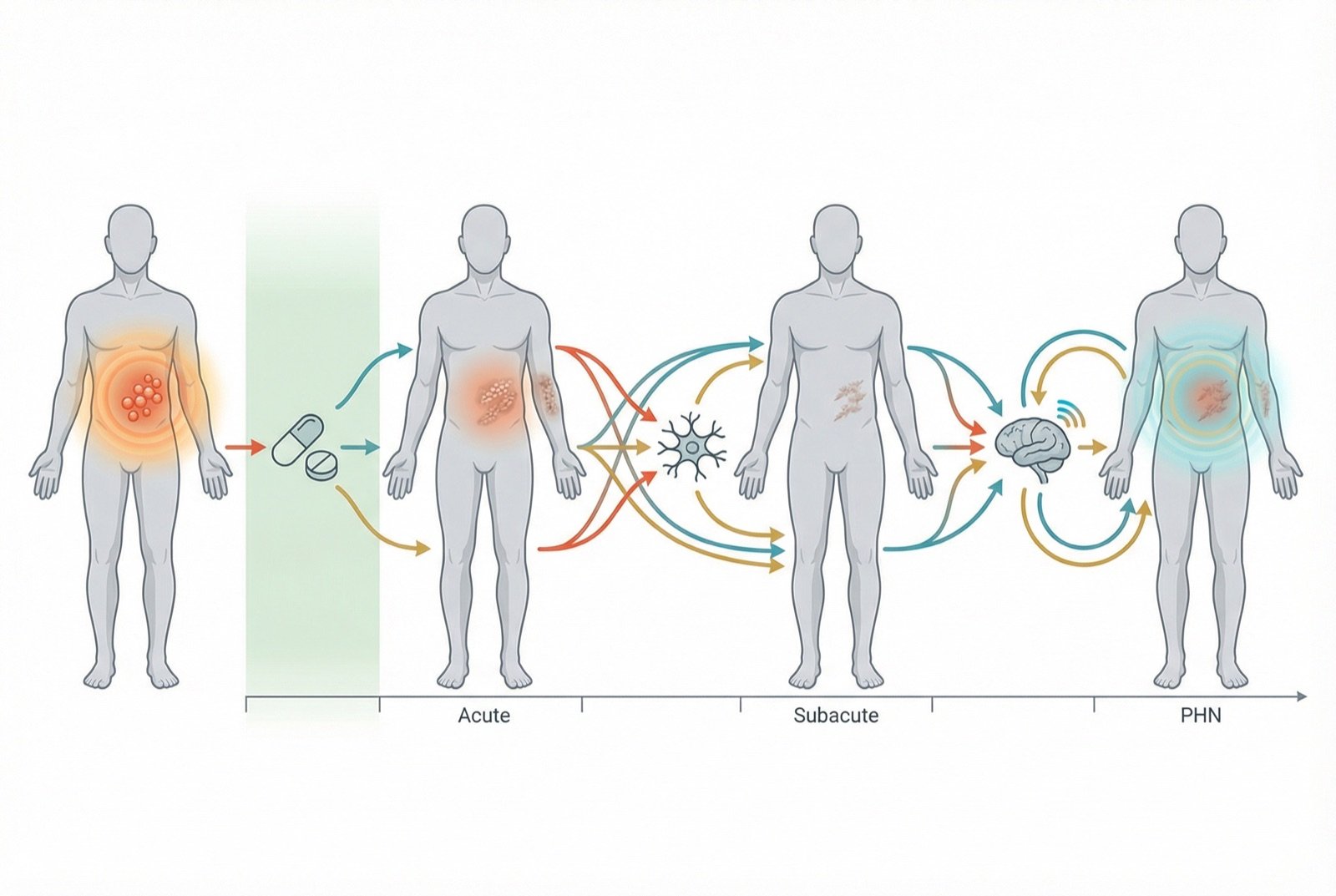 Línea de tiempo desde el herpes zóster hasta la neuralgia posherpética: fase aguda, fase subaguda y NPH crónica, con la ventana crítica para el tratamiento antiviral
