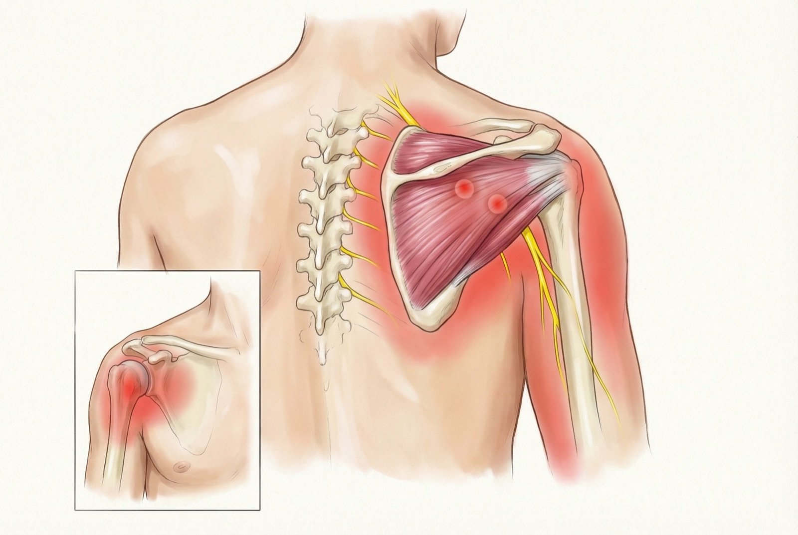 Puntos gatillo del infraespinoso con patrón de dolor referido: el TrP1 en la porción medial de la fosa infraespinosa refiere dolor profundo a la cara anterior del hombro y al deltoides anterior, e imita la tendinitis bicipital. La flecha muestra la paradoja clínica: músculo posterior, dolor anterior.