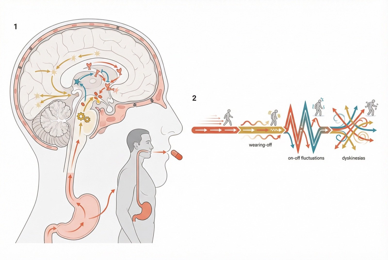 Mecanismo de acción de la levodopa: conversión en dopamina en el cerebro, compensación de la deficiencia dopaminérgica nigroestriatal y evolución de las complicaciones motoras.