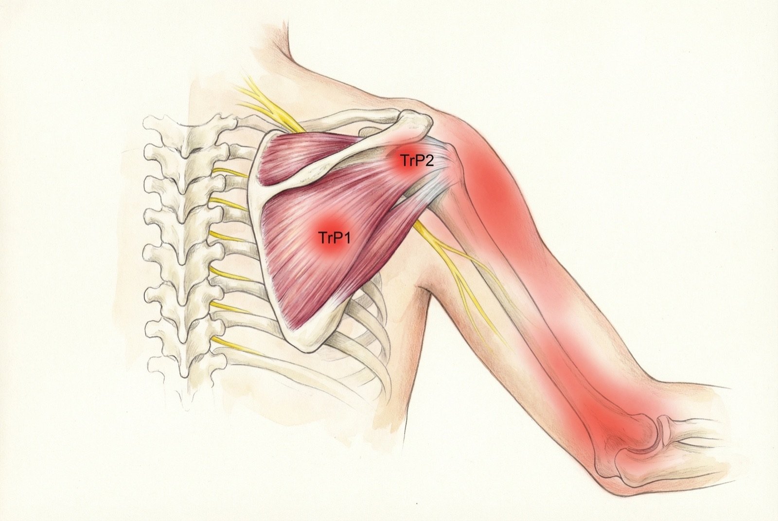 Puntos gatillo del supraespinoso: TrP1 (vientre medio) y TrP2 (porción lateral) con patrón de dolor referido en la cara lateral del hombro, deltoides medio y brazo lateral. Área de dolor profundo en rojo superpuesta a la topografía del deltoides.