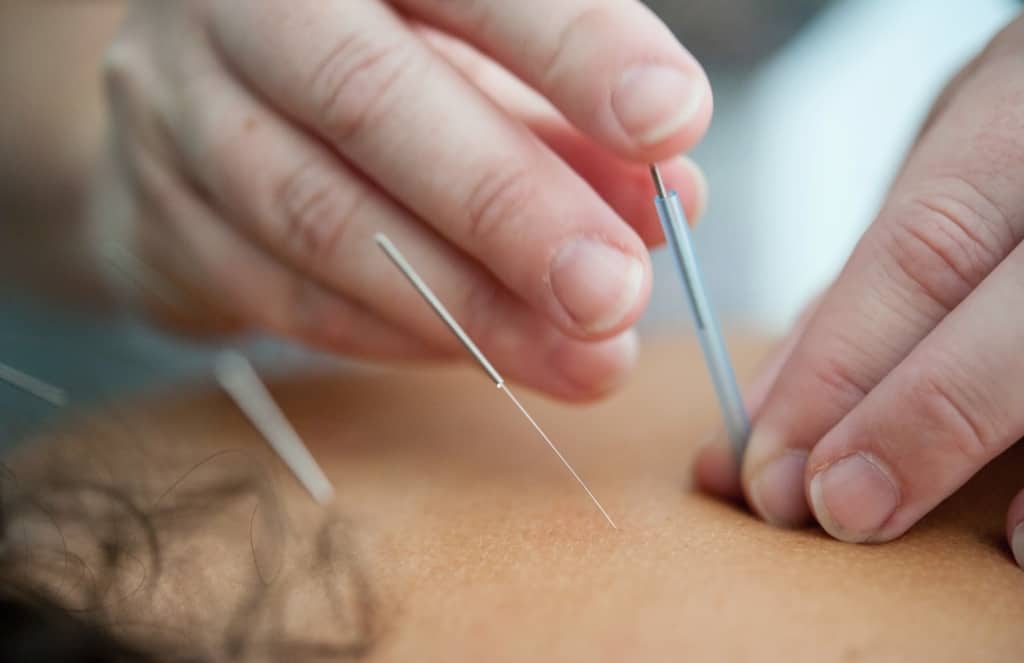 tratamento acupuntura