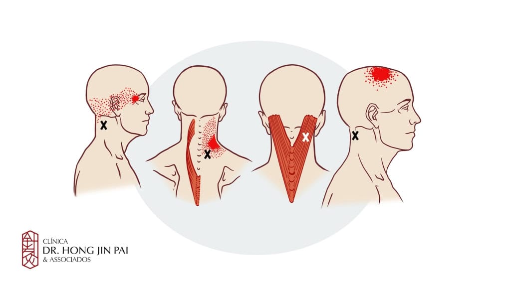 Sindrome Dolorosa Miofascial Cervical Dor no pescoco