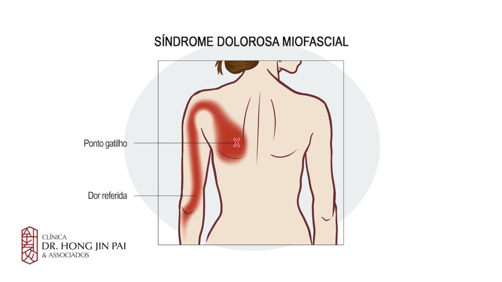 sindrome dolorosa miofsacial