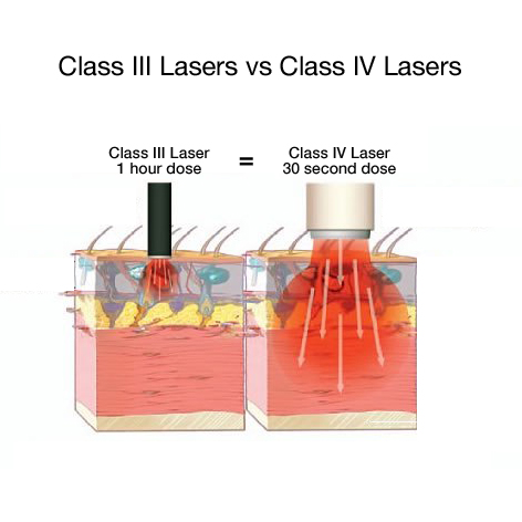 laser alta intensidade
